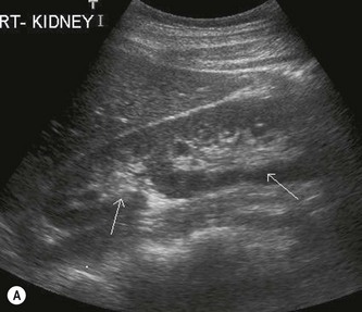 Ultrasound of the renal tract | Radiology Key