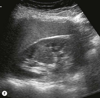 Ultrasound of the renal tract | Radiology Key