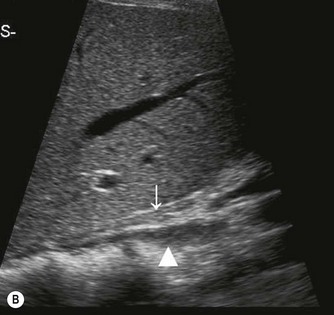 removal of adrenal glands