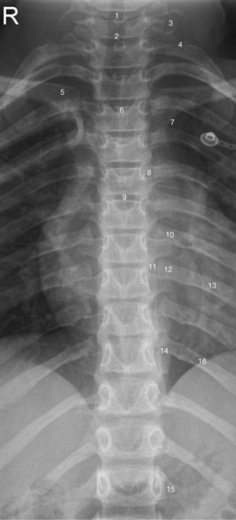 The spinal column and its contents | Radiology Key
