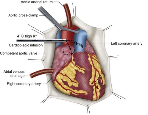 aortic cross clamp
