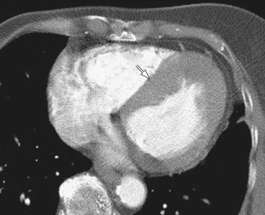 hypertrophic cardiomyopathy ct hypertrophy septal enhanced asymmetric contrast patient arrow shows figure