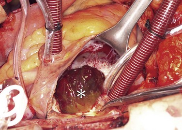 Intracavitary Left Ventricular Lipoma