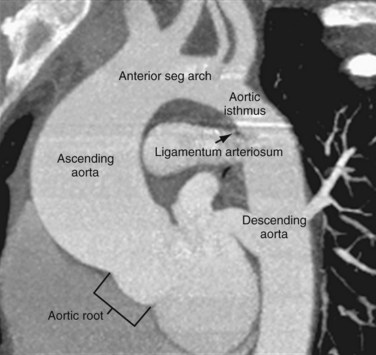 Normal Aorta Size Ct