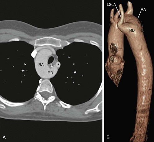 Arterial Anatomy of the Thorax | Radiology Key