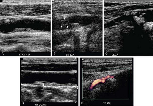 Ultrasound Of Carotid Artery