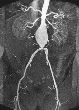 The Abdominal Aorta Radiology Key