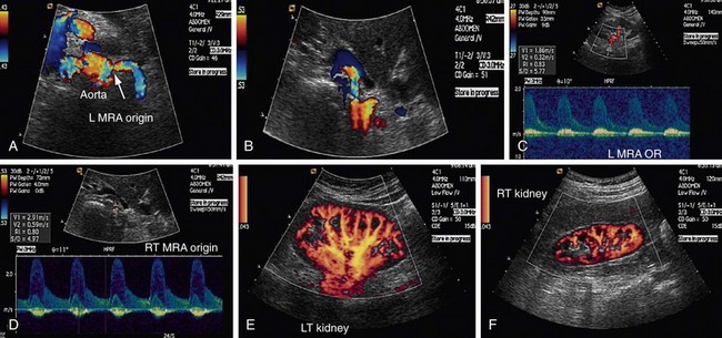 Renal Artery Stenosis Protocol Ultrasound