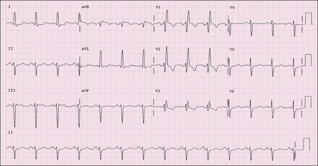 ivcd ecg images