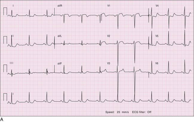 ivcd with lbbb