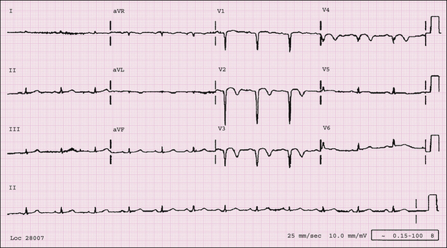 Electrocardiography | Radiology Key