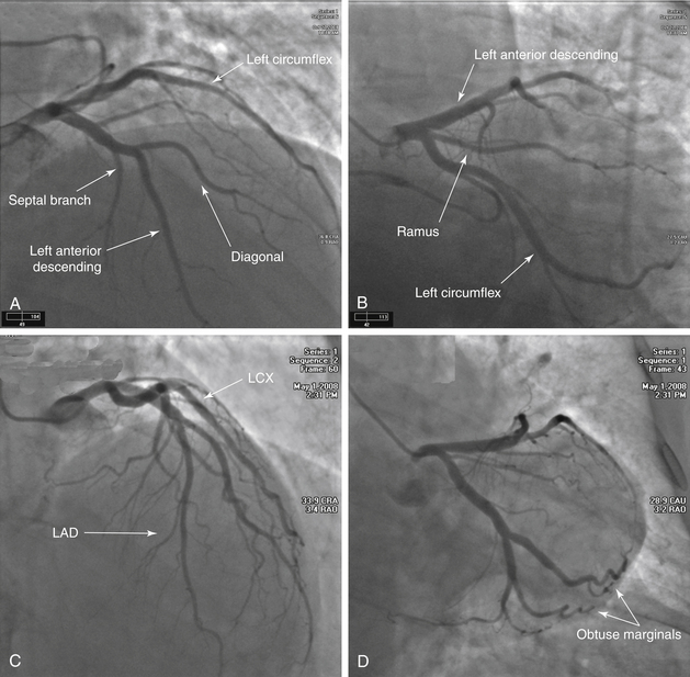 angiogram