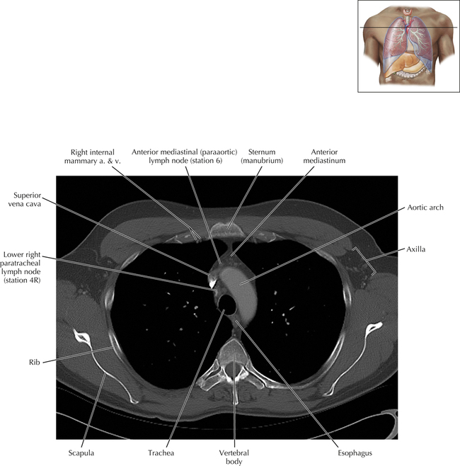 Thoracic Lymph Nodes | Radiology Key
