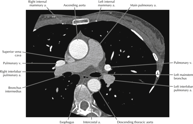 Cardiac Anatomy Using CT | Radiology Key