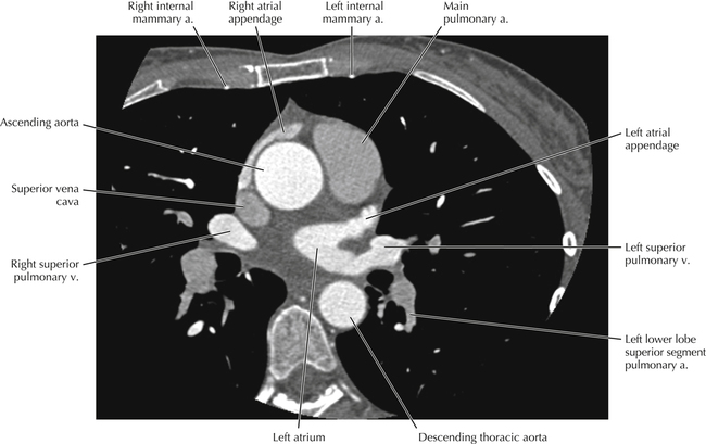 Heart Ct Scan Labeled