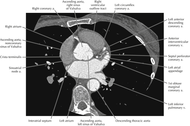 [영상의학] cardiac anatomy using CT : 네이버 블로그