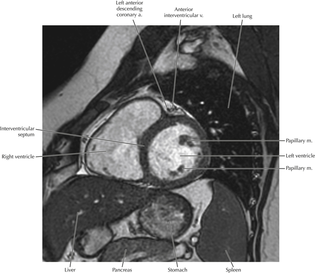 Cardiac Anatomy Using MR | Radiology Key