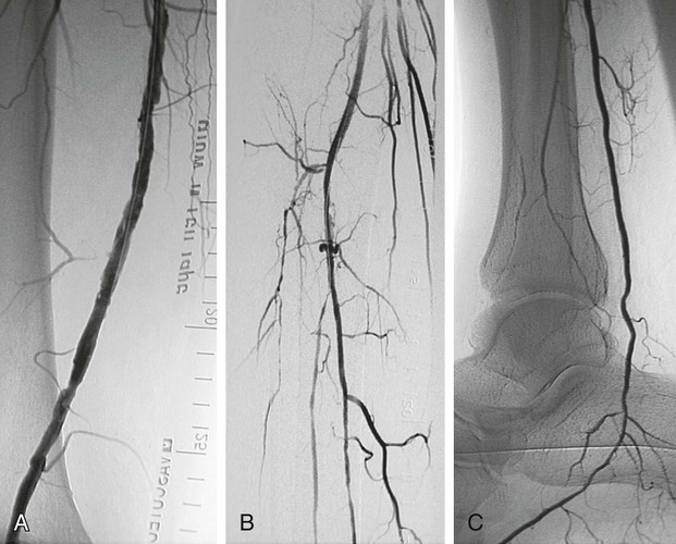 acute-lower-extremity-ischemia-radiology-key