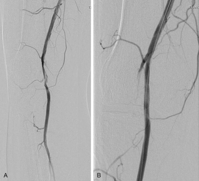 Acute Lower Extremity Ischemia | Radiology Key