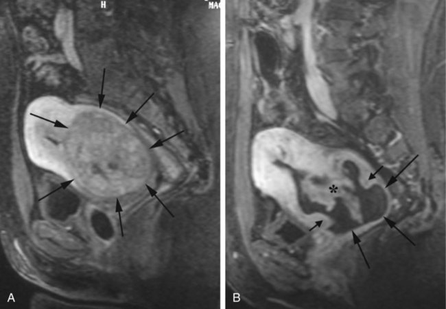 Uterine Fibroid Embolization Radiology Key