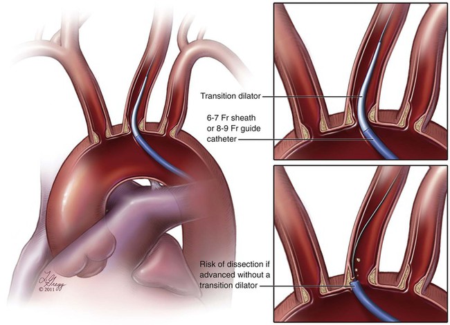 Carotid Revascularization Radiology Key