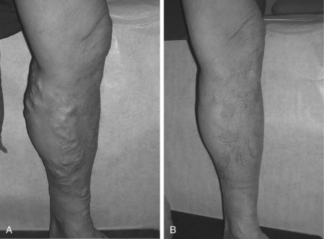 Great Saphenous Vein Ablation | Radiology Key