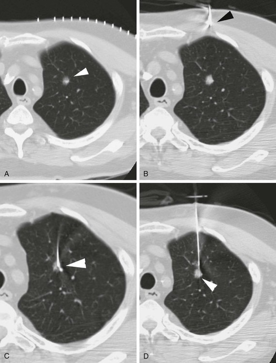 Percutaneous Biopsy Radiology Key 7882