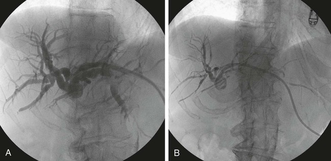 Management Of Malignant Biliary Tract Obstruction | Radiology Key