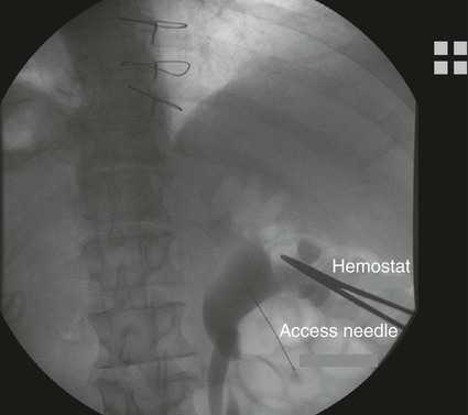 percutaneous nephrostomy