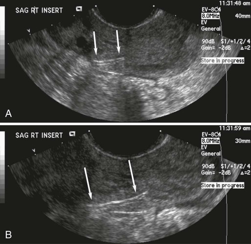 Fallopian Tube Interventions 