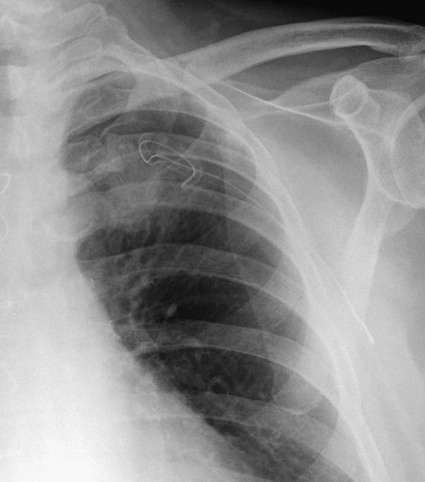 Percutaneous Biopsy of the Lung, Mediastinum, and Pleura | Radiology Key