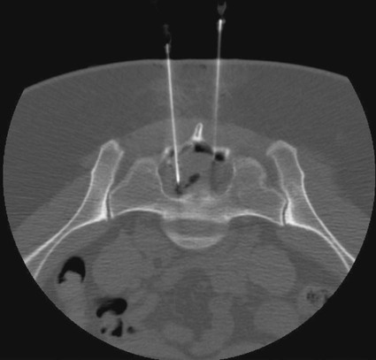 Image-Guided Intervention for Symptomatic Tarlov Cysts | Radiology Key