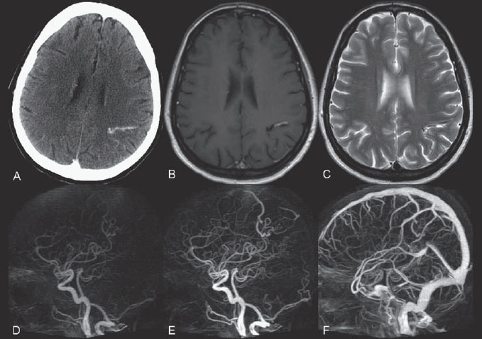 2 Brain Arteriovenous Malformations Radiology Key