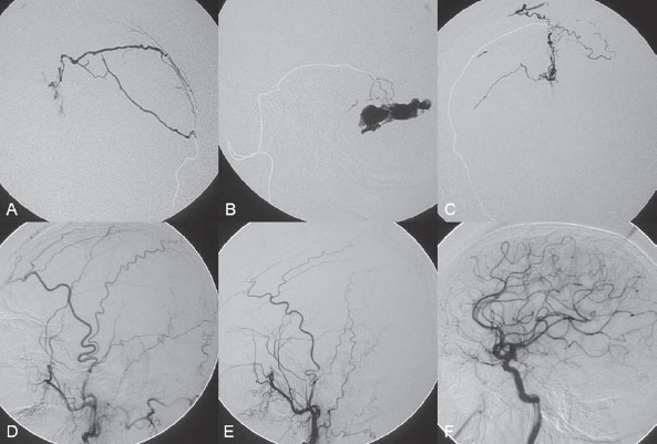 3 Cranial Dural Arteriovenous Shunts | Radiology Key