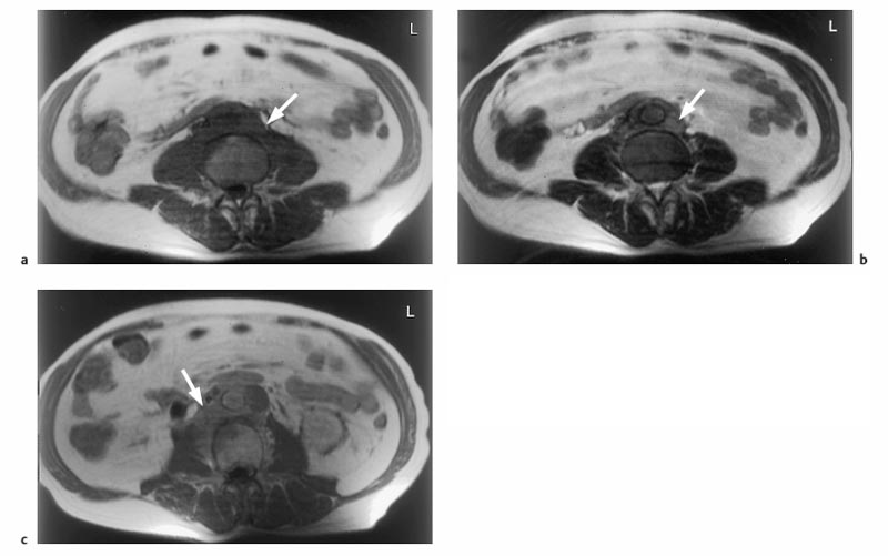 The Retroperitoneum Radiology Key