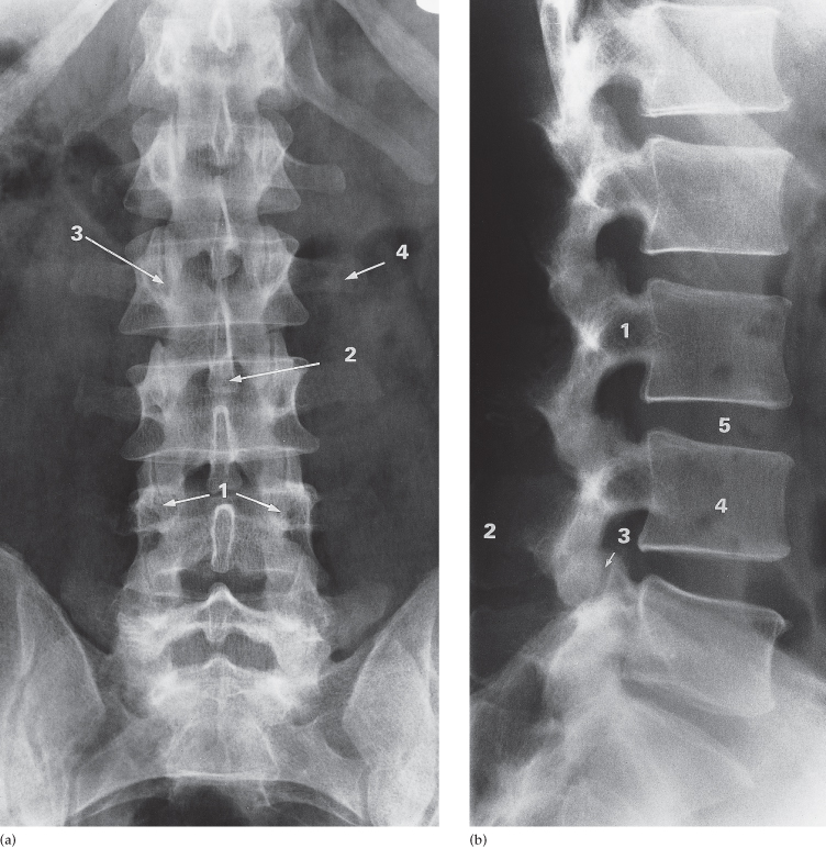 Yelek para transferi çelenk  Spine | Radiology Key