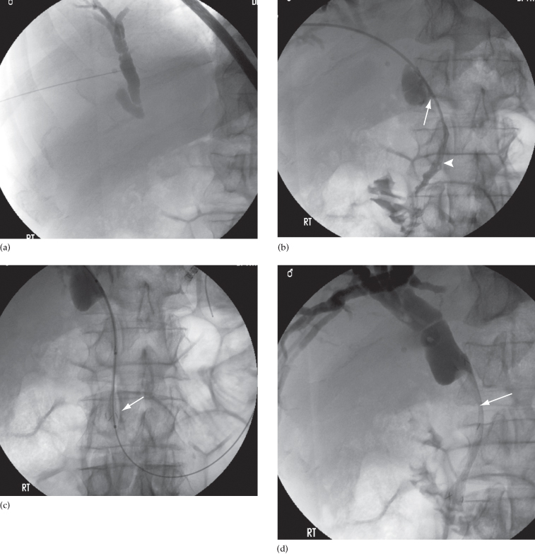 Vascular And Interventional Radiology Radiology Key