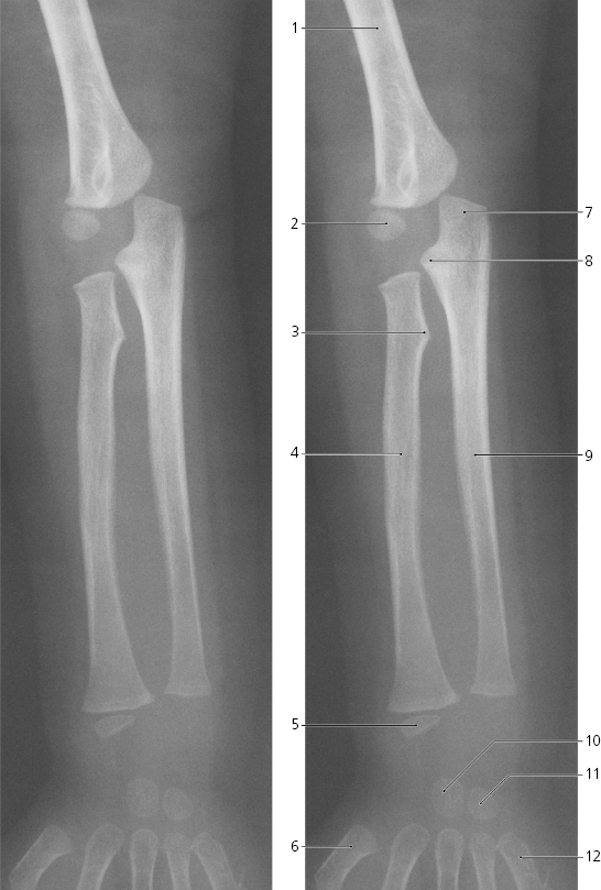 Labelled Radius Bone Radiography Forearm Radius Ulna Capitulum 5192