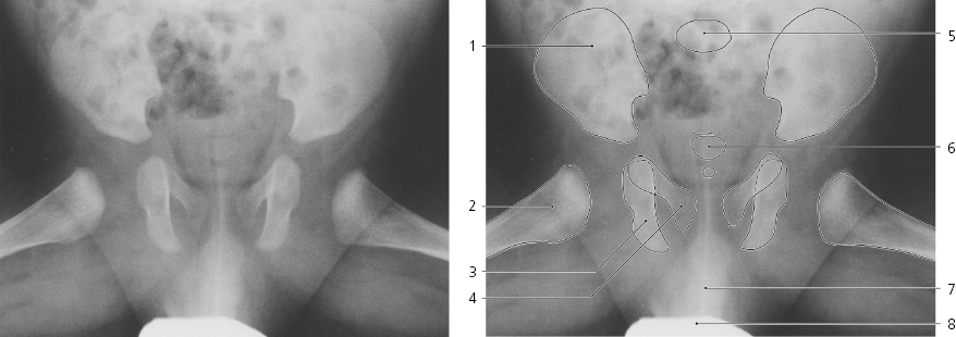 Рентген тазобедренного сустава в двух проекциях фото