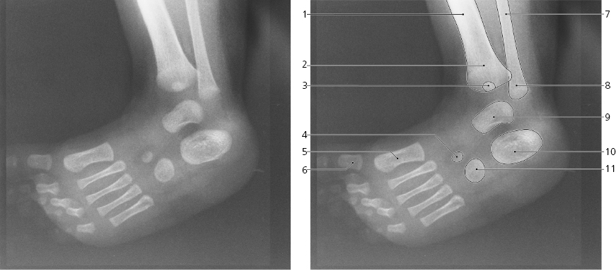 and Foot | Radiology Key
