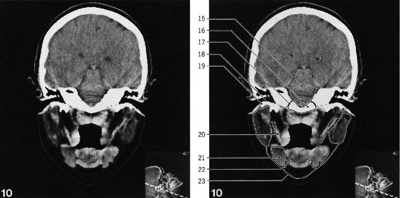 Skull Radiology Key