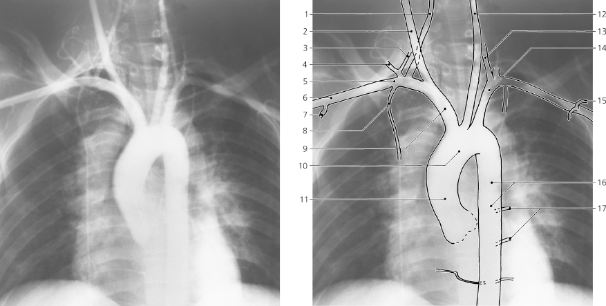 and Great Vessels | Radiology Key