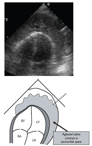 Pericardium | Radiology Key