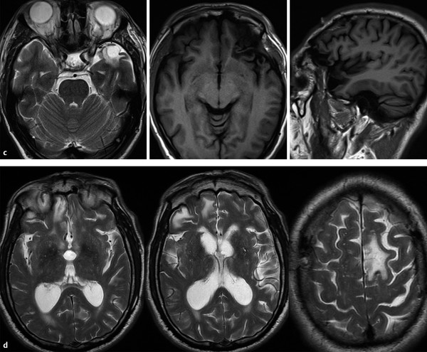 Neuroimaging of Traumatic Brain Injury | Radiology Key