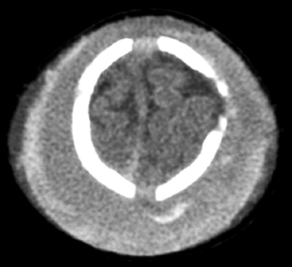 Pediatric Head Trauma | Radiology Key