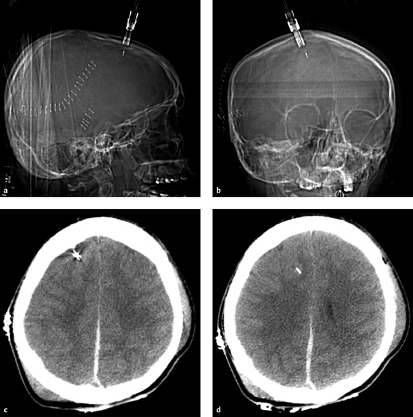 Postoperative Imaging Of Traumatic Brain Injury | Radiology Key