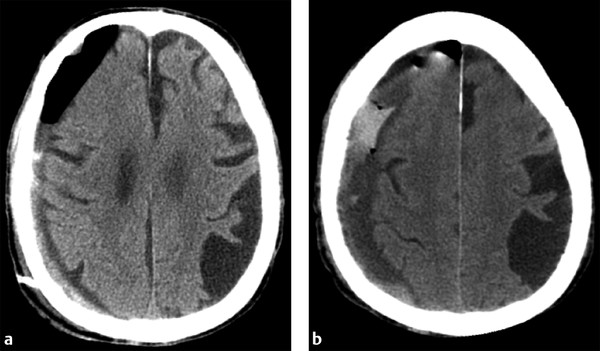 Postoperative Imaging of Traumatic Brain Injury | Radiology Key
