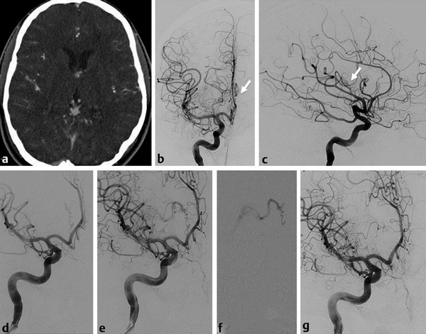 11-the-anterior-communicating-artery-complex-radiology-key