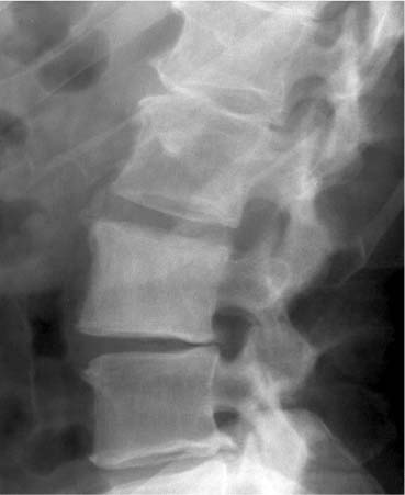 26 Paget Disease in Lumbar Vertebra | Radiology Key