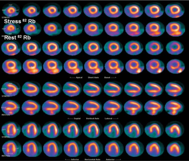 41 Abnormal PET scan | Radiology Key